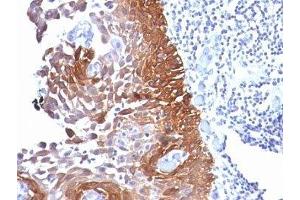 Formalin-fixed, paraffin-embedded human cervical carcinoma stained with Cytokeratin 18 antibody. (Cytokeratin 18 anticorps)