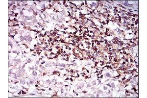 Immunohistochemical analysis of paraffin-embedded bladder cancer tissues using CD68 mouse mAb with DAB staining.