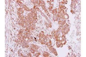 IHC-P Image Immunohistochemical analysis of paraffin-embedded human breast cancer, using PIM2, antibody at 1:250 dilution.