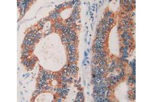 IHC-P analysis of Human Rectum Cancer Tissue, with DAB staining. (Prolactin Receptor anticorps  (AA 25-234))