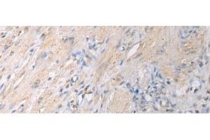 Immunohistochemistry of paraffin-embedded Human gastric cancer tissue using GNAI1 Polyclonal Antibody at dilution of 1:130(x200)