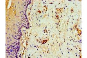 Immunohistochemistry of paraffin-embedded human cervical cancer using ABIN7144328 at dilution of 1:100 (TAP1 anticorps  (AA 524-808))