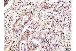 Formalin-fixed and paraffin embedded human colon carcinoma tissue labeled with Anti Phospho-MAP3K8/Tpl2 (Ser400) Polyclonal Antibody, Unconjugated (ABIN746573) at 1:200 followed by conjugation to the secondary antibody and DAB staining. (MAP3K8 anticorps  (pSer400))