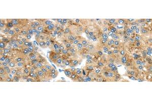Immunohistochemistry of paraffin-embedded Human liver cancer using TMED4 Polyclonal Antibody at dilution of 1/45 (TMED4 anticorps)