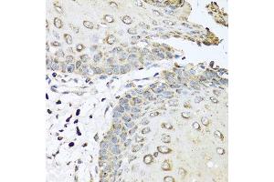 Immunohistochemistry of paraffin-embedded human esophagus using IL6 antibody at dilution of 1:100 (40x lens). (IL-6 anticorps)