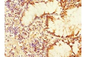 Immunohistochemistry of paraffin-embedded human colon cancer using ABIN7169162 at dilution of 1:100 (PLK3 anticorps  (AA 487-646))
