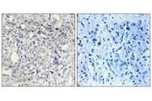 Immunohistochemistry analysis of paraffin-embedded human liver carcinoma tissue, using Heparin Cofactor II antibody. (SERPIND1 anticorps)