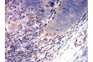 Immunohistochemical analysis of paraffin-embedded rectum cancer tissues using CD163 mouse mAb with DAB staining. (CD163 anticorps  (AA 42-259))
