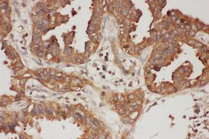 Anti-Calpain 1 antibody, IHC(P) IHC(P): Human Intestinal Cancer Tissue