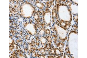 Immunohistochemistry of Human thyroid cancer using VIMP Polyclonal Antibody at dilution of 1:40 (Selenoprotein S anticorps)