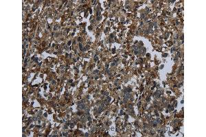 Immunohistochemistry of Human liver cancer using GLUL Polyclonal Antibody at dilution of 1:60