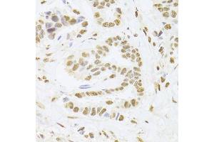 Immunohistochemistry of paraffin-embedded human breast cancer using ANP32A Antibody.