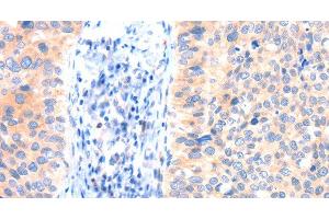 Immunohistochemistry of paraffin-embedded Human cervical cancer tissue using ANK3 Polyclonal Antibody at dilution 1:50 (Ankyrin G anticorps)