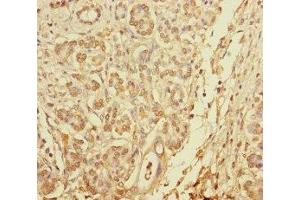 Immunohistochemistry of paraffin-embedded human pancreatic cancer using ABIN7145610 at dilution of 1:100