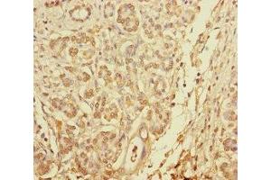 Immunohistochemistry of paraffin-embedded human pancreatic cancer using ABIN7145610 at dilution of 1:100 (Pallidin anticorps  (AA 1-170))