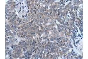 Immunohistochemistry of paraffin-embedded human thyroid cancer using ABIN7190935 at dilution of 1:20 (HES1 anticorps)
