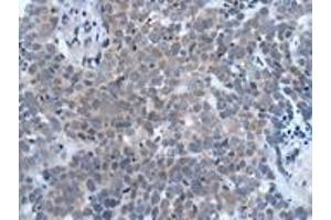 Immunohistochemistry of paraffin-embedded human thyroid cancer using ABIN7190935 at dilution of 1:20