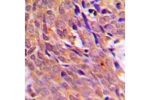 Immunohistochemical analysis of CHK1 staining in human breast cancer formalin fixed paraffin embedded tissue section.