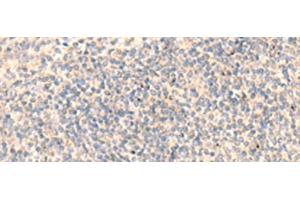 Immunohistochemistry of paraffin-embedded Human tonsil tissue using ADAMTS2 Polyclonal Antibody at dilution of 1:45(x200)