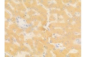 ABIN6258647 and ABIN6273571 at 1/100 staining human hepatocellular carcinoma by IHC-P.