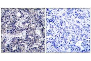 Immunohistochemical analysis of paraffin-embedded human breast carcinoma tissue using PKR (Ab-446) antibody (E021272). (EIF2AK2 anticorps)