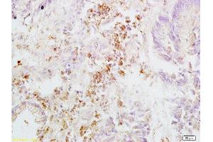 Formalin-fixed and paraffin embedded human rectal carcinoma labeled with Anti-Integrin beta 3/CD61 Polyclonal Antibody, Unconjugated  at 1:200, followed by conjugation to the secondary antibody and DAB staining (Integrin beta 3 anticorps  (AA 27-120))