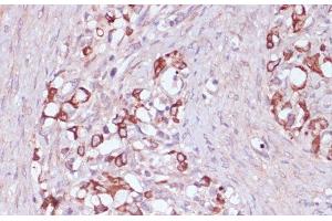 Immunohistochemistry of paraffin-embedded Human oophoroma using UGT2B15 Polyclonal Antibody at dilution of 1:100 (40x lens). (UGT2B15 anticorps)