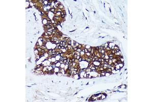 Immunohistochemistry of paraffin-embedded Human breast cancer using MRPL30 Rabbit pAb (ABIN7268567) at dilution of 1:100 (40x lens). (MRPL30 anticorps  (AA 1-161))