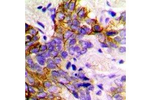 Immunohistochemical analysis of GABARAP staining in human breast cancer formalin fixed paraffin embedded tissue section. (GABARAP anticorps)