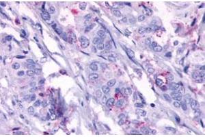 Immunohistochemistry (Formalin/PFA-fixed paraffin-embedded sections) of human colon cancer, neoplastic cells with GPR124 polyclonal antibody .