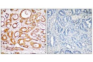 Immunohistochemistry analysis of paraffin-embedded human colon carcinoma tissue, using RPS19 antibody. (RPS19 anticorps  (Internal Region))