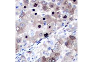 Immunohistochemical analysis of Topoisomerase 2 alpha staining in human liver cancer formalin fixed paraffin embedded tissue section. (Topoisomerase II alpha anticorps  (N-Term))