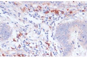 Immunohistochemistry of paraffin-embedded Human colon carcinoma using VASP Polyclonal Antibody at dilution of 1:100 (40x lens). (VASP anticorps)