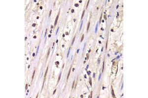 Immunohistochemistry of paraffin-embedded human mammary cancer using LSM4 antibody.