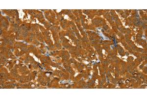 Immunohistochemistry of paraffin-embedded Human thyroid cancer using PYGM Polyclonal Antibody at dilution of 1:30 (PYGM anticorps)