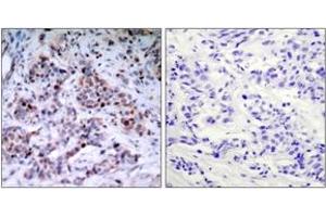 Immunohistochemistry analysis of paraffin-embedded human breast carcinoma, using NF-kappaB p65 (Phospho-Thr435) Antibody. (NF-kB p65 anticorps  (pThr435))