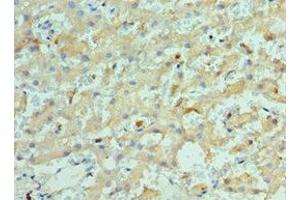 Immunohistochemistry of paraffin-embedded human liver cancer using ABIN7157649 at dilution of 1:100