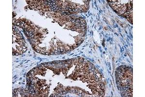Immunohistochemical staining of paraffin-embedded Carcinoma of liver tissue using anti-FAHD2A mouse monoclonal antibody. (FAHD2A anticorps)