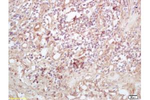 Formalin-fixed and paraffin embedded human lung carcinoma labeled with Rabbit Anti Exportin 1/CRM1 Polyclonal Antibody, Unconjugated (ABIN1714155) at 1:200 followed by conjugation to the secondary antibody and DAB staining