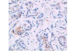 Detection of IL4 in Human Breast Cancer Tissue using Monoclonal Antibody to Interleukin 4 (IL4)