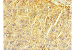 Immunohistochemistry of paraffin-embedded human liver cancer using ABIN7161741 at dilution of 1:100