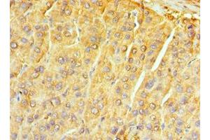 Immunohistochemistry of paraffin-embedded human liver cancer using ABIN7161741 at dilution of 1:100 (NTRK3 anticorps  (AA 40-300))