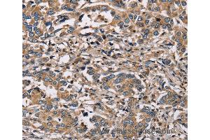 Immunohistochemistry of Human liver cancer using HSD17B12 Polyclonal Antibody at dilution of 1:30 (HSD17B12 anticorps)