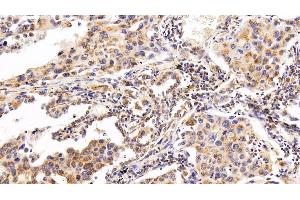 Detection of RNASE3 in Human Lung cancer Tissue using Polyclonal Antibody to Ribonuclease A3 (RNASE3) (RNASE3 anticorps  (AA 30-154))