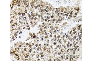 Immunohistochemistry of paraffin-embedded Human lung cancer using BAF60a Polyclonal Antibody at dilution of 1:100 (40x lens). (SMARCD1 anticorps)