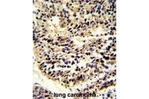 Formalin-fixed and paraffin-embedded human lung carcinoma reacted with BCL2A1 Antibody (Center), which was peroxidase-conjugated to the secondary antibody, followed by DAB staining.