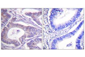 Immunohistochemistry analysis of paraffin-embedded human colon carcinoma tissue, using Vimentin antibody. (Vimentin anticorps  (C-Term))