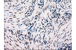 Immunohistochemical staining of paraffin-embedded Carcinoma of kidney tissue using anti-BRAFmouse monoclonal antibody. (BRAF anticorps)