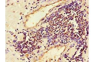 Immunohistochemistry of paraffin-embedded human prostate cancer using ABIN7160009 at dilution of 1:100 (JNK anticorps  (AA 5-300))