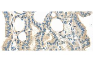 Immunohistochemistry of paraffin-embedded Human thyroid cancer tissue using WNT6 Polyclonal Antibody at dilution 1:35 (WNT6 anticorps)